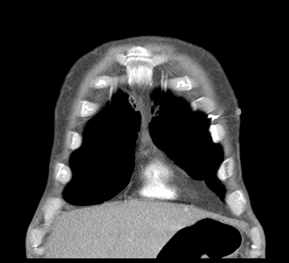 File:Obstructive superior vena cava tumor thrombus (Radiopaedia 28046-28306 B 9).jpg