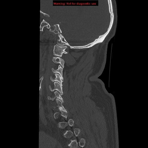 File:Occipital condyle fracture (Radiopaedia 18366-18208 Sagittal bone window 29).jpg