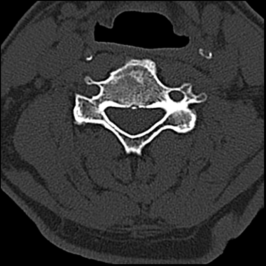 Occipital condyle fracture (type 1) (Radiopaedia 87670-104084 Axial bone window 48).jpg