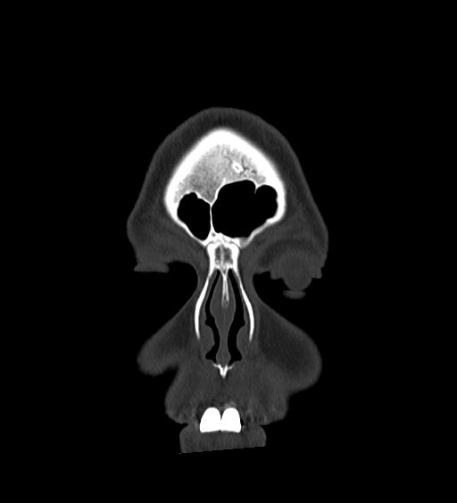 Occipital spur and Currarino type A atlas anomaly (Radiopaedia 87027-103285 Coronal bone window 26).jpg