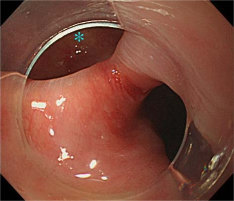 Hood-assisted upper endoscopy clarified the border of Zenker diverticulum ( and upper esophagus)