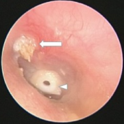 Acquired cholesteatoma of attic in left ear