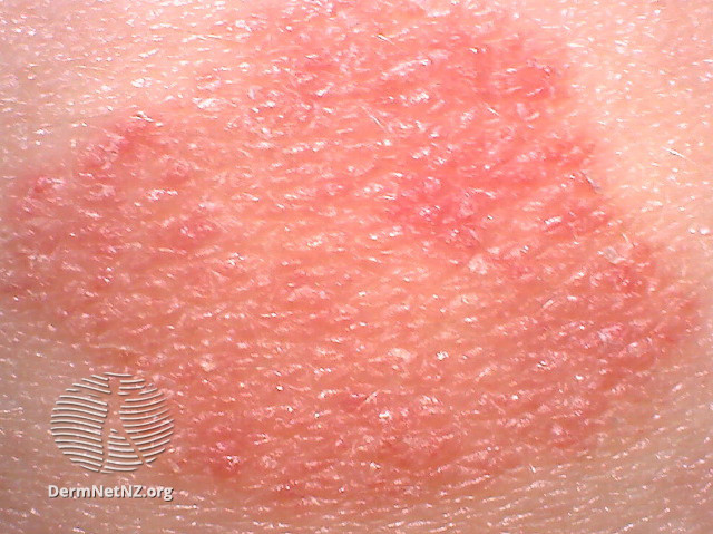 File:Red patch of psoriasis (DermNet NZ colour-red).jpg