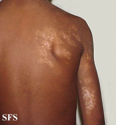 File:Vitiligo (Dermatology Atlas 22).jpg