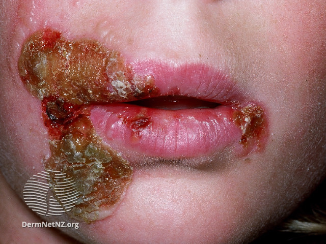File:(DermNet NZ herpes-simplex-labialis-27).jpg