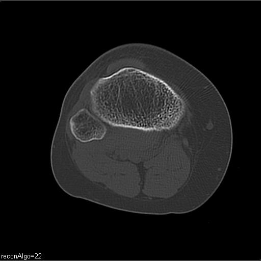 File:ACL avulsion fracture (Radiopaedia 33833-34994 Axial bone window 22).jpg