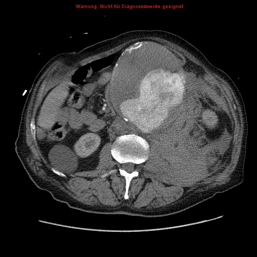 File:Abdominal aortic aneurysm- extremely large, ruptured (Radiopaedia 19882-19921 Axial C+ arterial phase 32).jpg