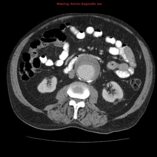 Abdominal aortic aneurysm (Radiopaedia 10122-10660 Axial C+ portal venous phase 38).jpg