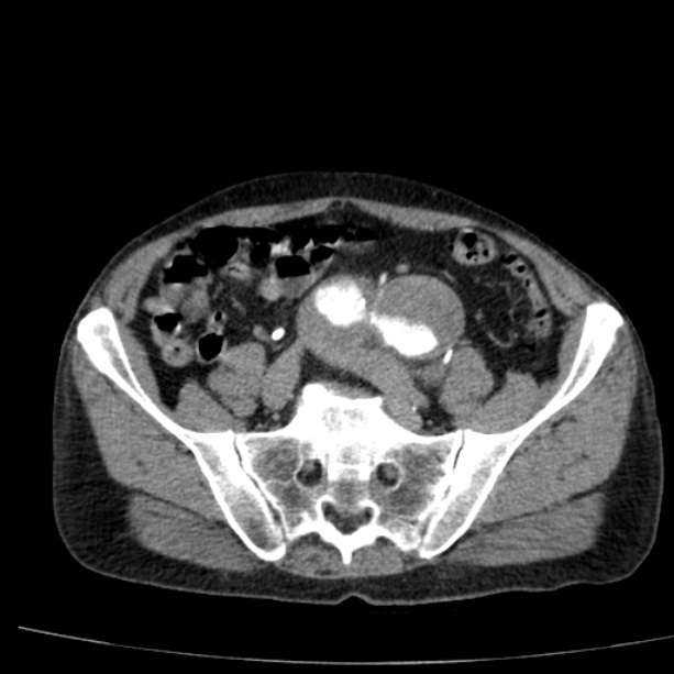 Abdominal aortic aneurysm (Radiopaedia 29248-29660 Axial C+ arterial phase 65).jpg