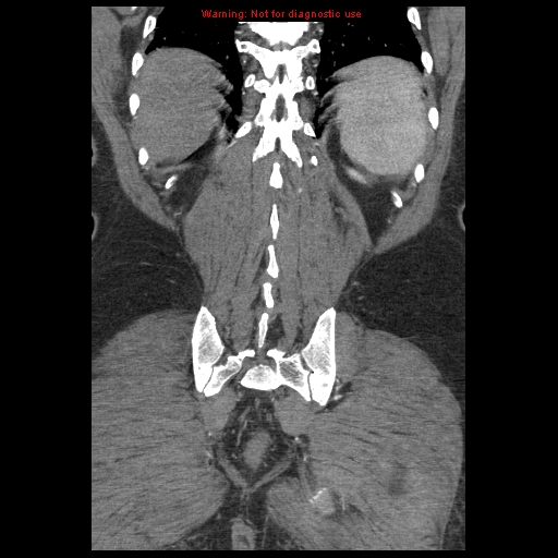 Abdominal aortic aneurysm (Radiopaedia 8190-9038 Coronal C+ arterial phase 108).jpg
