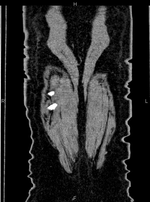 Abdominal aortic aneurysm (Radiopaedia 83094-97462 Coronal renal cortical phase 89).jpg