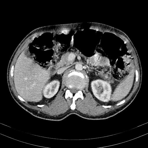 Abdominal aortic aneurysm (Radiopaedia 83581-98689 Axial C+ portal venous phase 40).jpg