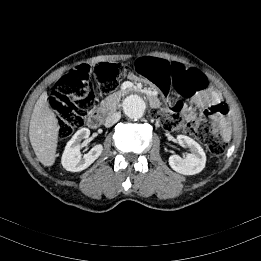 File:Abdominal aortic aneurysm (Radiopaedia 83581-98689 Axial C+ portal venous phase 50).jpg