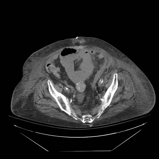 Abdominal aortic aneurysm - impending rupture (Radiopaedia 19233-19247 Axial non-contrast 134).jpg