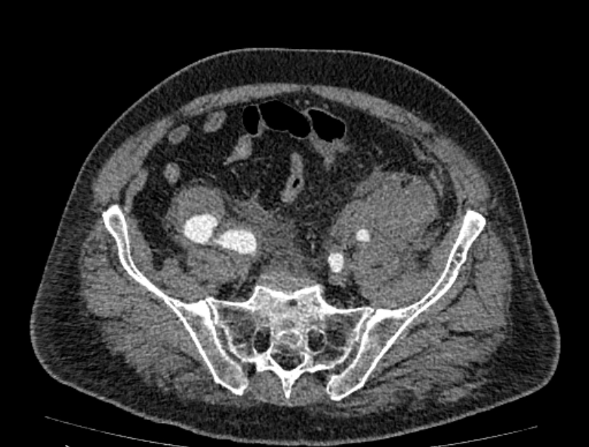 Abdominal aortic aneurysm rupture (Radiopaedia 54179-60362 Axial C+ portal venous phase 8).jpg