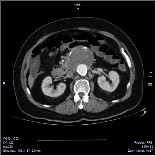 Abdominal aortic aneurysm with thrombus fissuration (Radiopaedia 47340-51926 Axial C+ arterial phase 22).jpg
