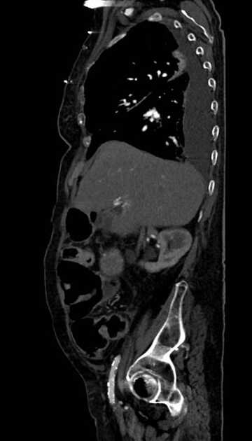 Abdominal aortic aneurysm with thrombus fissuration (Radiopaedia 73192-83919 Sagittal C+ arterial phase 103).jpg