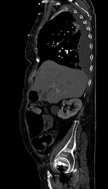 Abdominal aortic aneurysm with thrombus fissuration (Radiopaedia 73192-83919 Sagittal C+ arterial phase 106).jpg