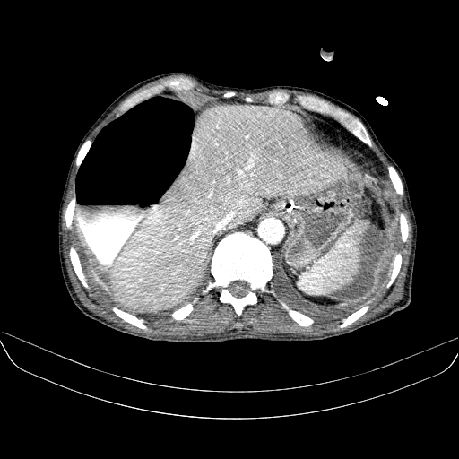 File:Abdominal collection due to previous cecal perforation (Radiopaedia 80831-94320 Axial C+ portal venous phase 32).jpg