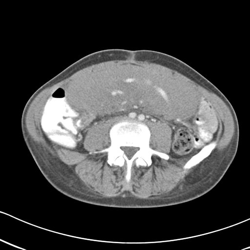File:Abdominal desmoid tumor (Radiopaedia 41007-43740 Axial C+ portal venous phase 41).png