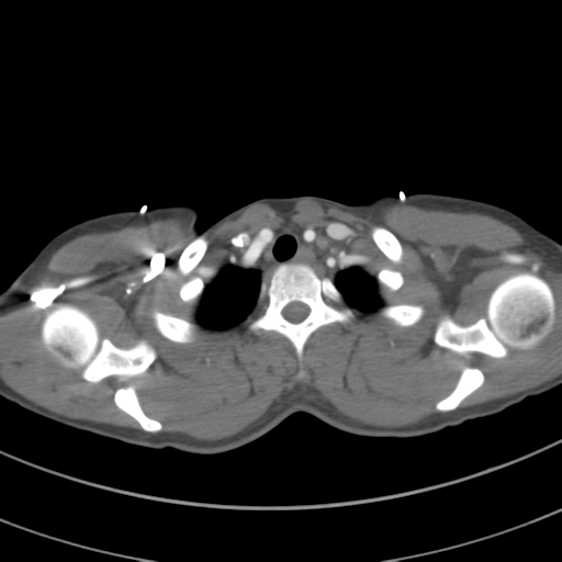 File:Abdominal multi-trauma - devascularised kidney and liver, spleen and pancreatic lacerations (Radiopaedia 34984-36486 Axial C+ arterial phase 12).png