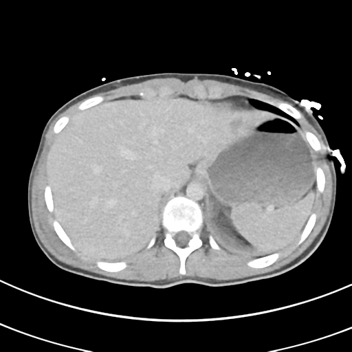 File:Abdominal multi-trauma - devascularised kidney and liver, spleen and pancreatic lacerations (Radiopaedia 34984-36486 Axial C+ delayed 11).png