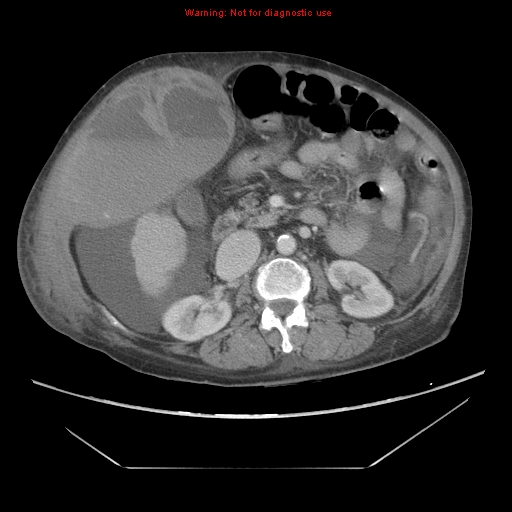 File:Abdominal wall hematoma (Radiopaedia 9427-10112 Axial C+ portal venous phase 45).jpg