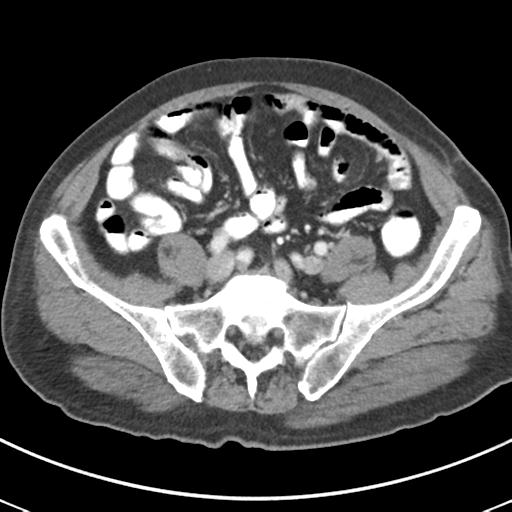 Abdominal wall metastasis from colorectal carcinoma (Radiopaedia 31016-31717 Axial C+ portal venous phase 55).jpg