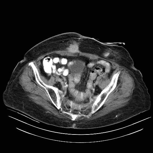 File:Abdominal wall recurrence after colorectal resection for cancer (Radiopaedia 23444-23523 Axial C+ portal venous phase 30).jpg
