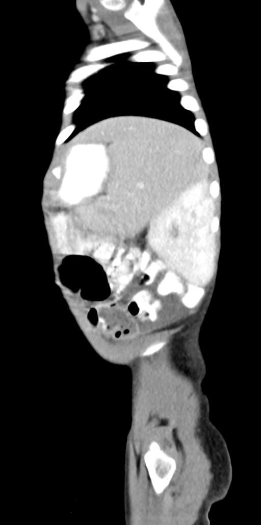 Abdominopelvic rhabdomyosarcoma (Radiopaedia 78356-90984 Sagittal C+ portal venous phase 17).jpg