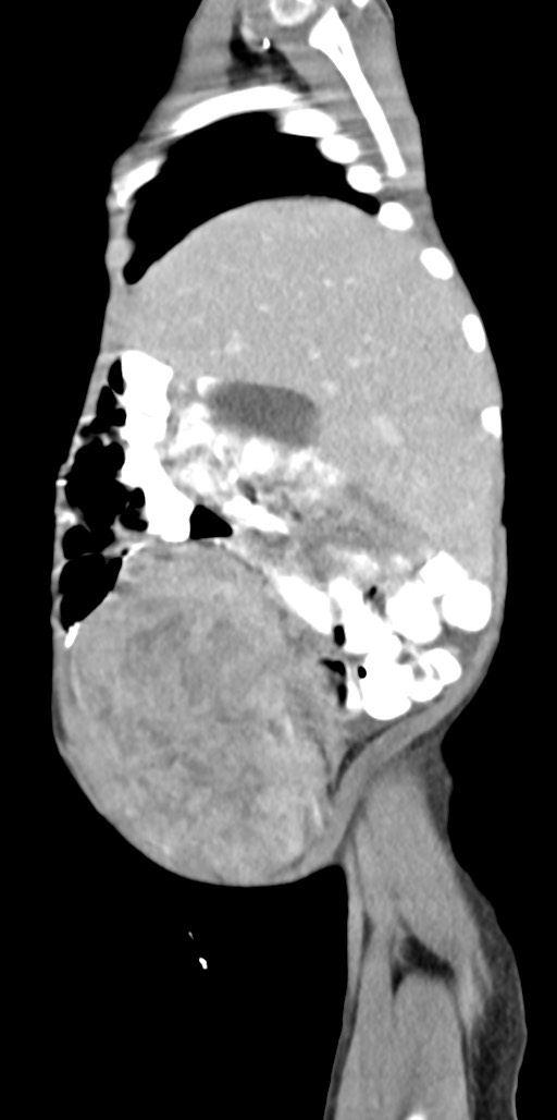 Abdominopelvic rhabdomyosarcoma (Radiopaedia 78356-90984 Sagittal C+ portal venous phase 81).jpg