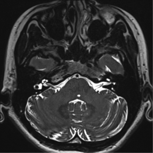 File:Abducens nerve palsy (Radiopaedia 51069-56648 Axial T2 fat sat 20).png