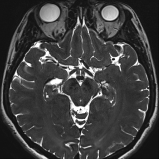 Abducens nerve palsy (Radiopaedia 51069-56648 Axial T2 fat sat 72).png