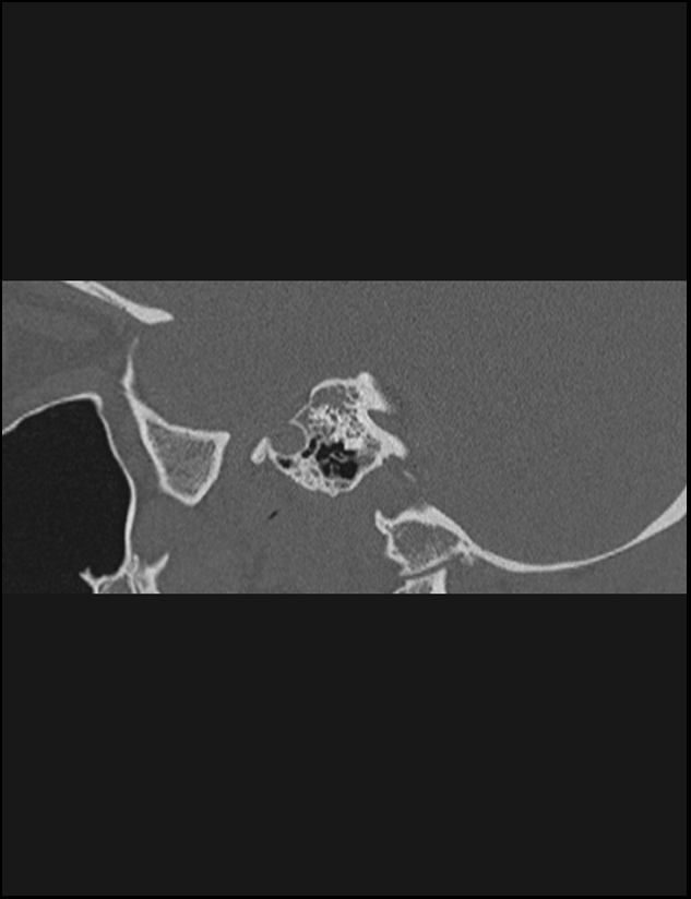 Aberrant right internal carotid artery (Radiopaedia 65191-74198 Sagittal non-contrast 71).jpg