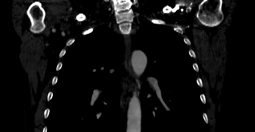 Accesory rib joint (Radiopaedia 71987-82452 Coronal bone window 1).jpg