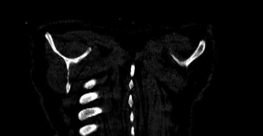 Accesory rib joint (Radiopaedia 71987-82452 Coronal bone window 94).jpg