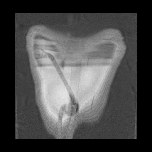 Accessory left horizontal fissure with lingular pneumonia (Radiopaedia 53763-59843 Coronal lung window 46).jpg