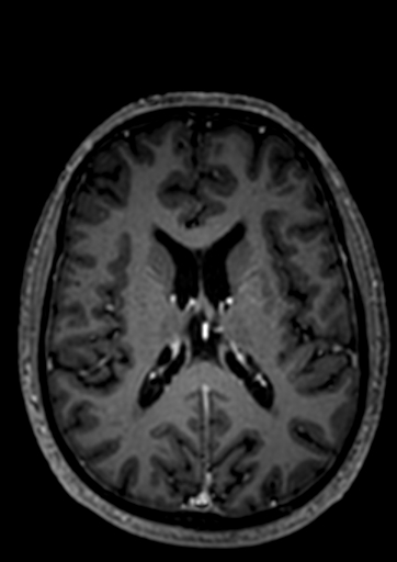 Accessory middle cerebral artery (Radiopaedia 73114-83828 Axial T1 C+ 4).jpg
