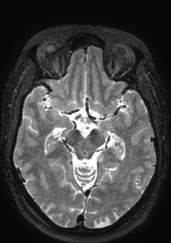Accessory middle cerebral artery (Radiopaedia 73114-83828 Axial T2 106).jpg