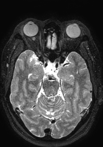 Accessory middle cerebral artery (Radiopaedia 73114-83828 Axial T2 126).jpg