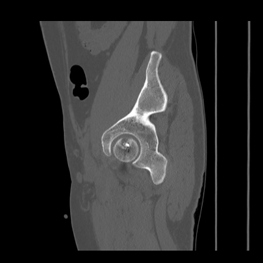 Acetabular and ilial fractures (Radiopaedia 59084-66378 Sagittal bone window 72).jpg