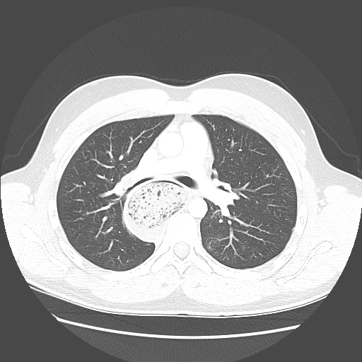 Achalasia (Radiopaedia 52507-58417 Axial lung window 26).jpg