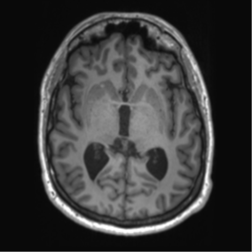 File:Achondroplasia (Radiopaedia 65109-74105 Axial T1 29).png