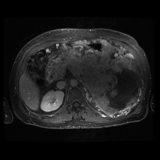 Acinar cell carcinoma of the pancreas (Radiopaedia 75442-86668 Axial T1 C+ fat sat 63).jpg