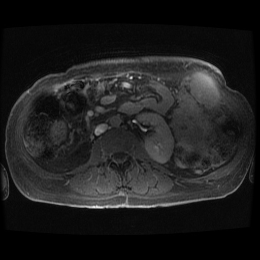 Acinar cell carcinoma of the pancreas (Radiopaedia 75442-86668 Axial late phase (~30 mins) 17).jpg