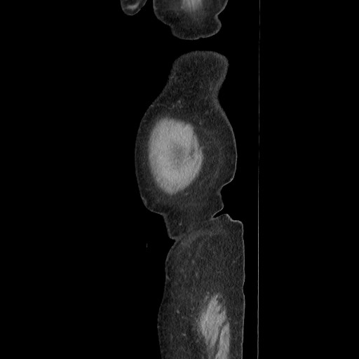 Acinar cell carcinoma of the pancreas (Radiopaedia 75442-86669 Sagittal C+ portal venous phase 21).jpg