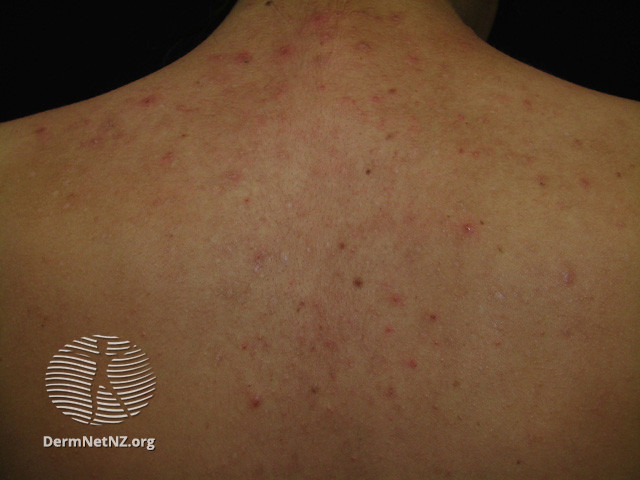 File:Acne affecting the back images (DermNet NZ acne-acne-back-142).jpg