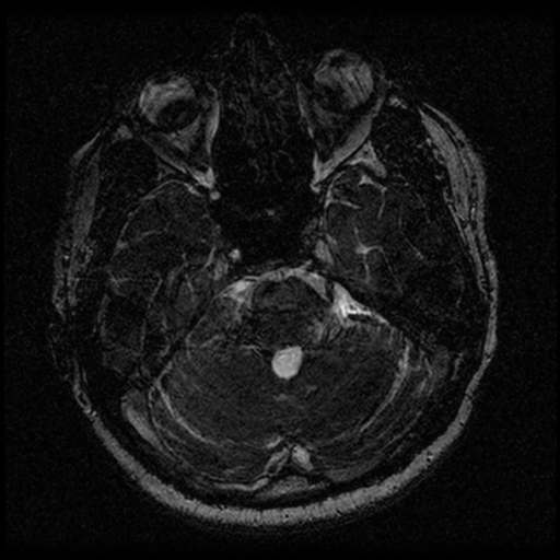 Acoustic schwannoma (Radiopaedia 33045-34060 Axial T2 44).png