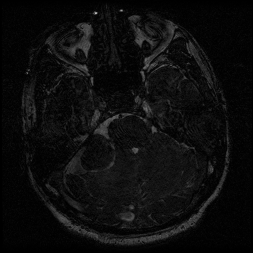 File:Acoustic schwannoma (Radiopaedia 39170-41387 Axial FIESTA 83).png