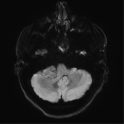 Acoustic schwannoma (Radiopaedia 50846-56358 Axial DWI 33).png